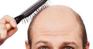 Nguyên nhân và phương pháp trị rụng tóc dẫn đến hói đầu
