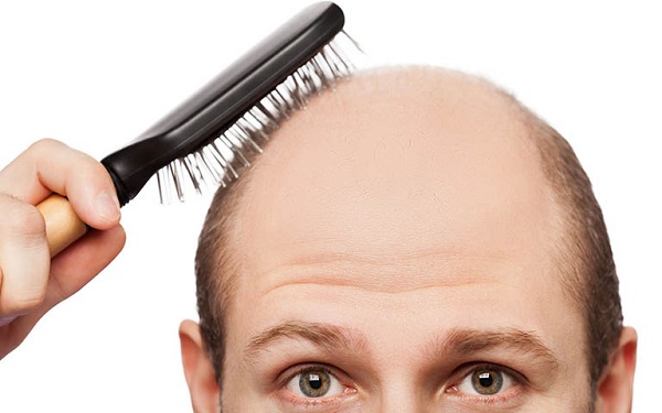 Nguyên nhân và phương pháp trị rụng tóc dẫn đến hói đầu