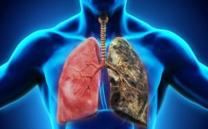 YHCT giới thiệu bài thuốc và món ăn điều trị lao phổi rất hiệu quả