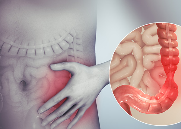 Hội chứng ruột kích thích là một hội chứng (IBS)