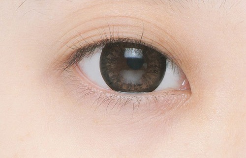 Mắt 3 mí là một dạng khiếm khuyết
