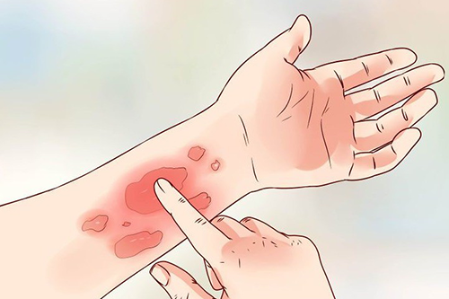 YHCT mách bạn một số bài thuốc cho chứng ngứa da vào mùa đông