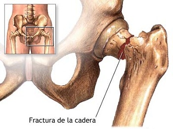Loãng xương gây chứng xốp xương dễ gãy khi tác động